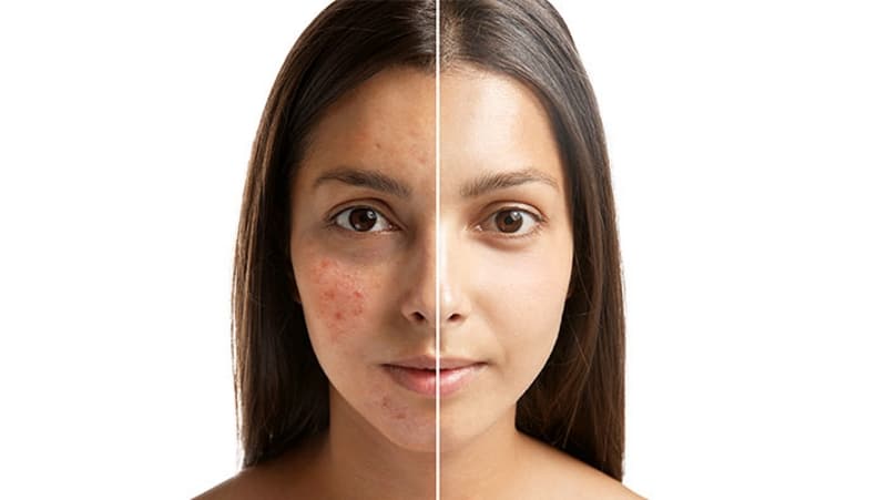 ακμη προσωπο